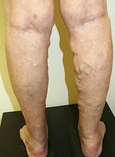Varicose veins on the legs