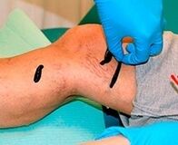 Bleeding for varicose veins
