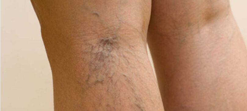 Varicose veins on the legs