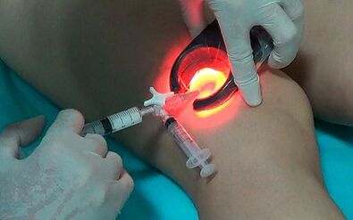 Sclerotherapy as a way to treat varicose veins on the legs