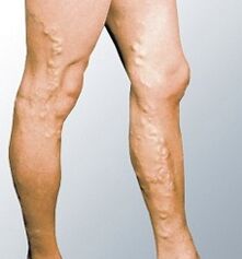 Manifestations of varicose veins
