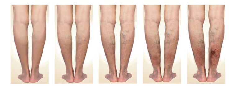 Stadiums of varicose veins