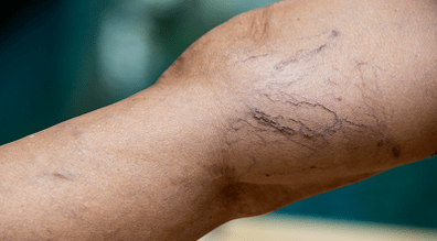 Prevention of varicose veins