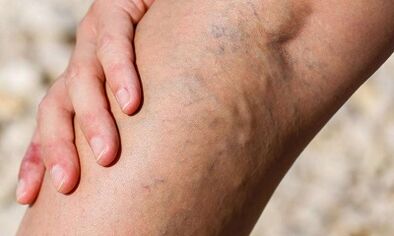 Causes of varicose veins