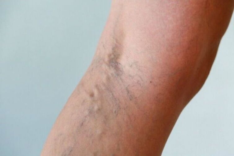 Treatment of varicose veins in women