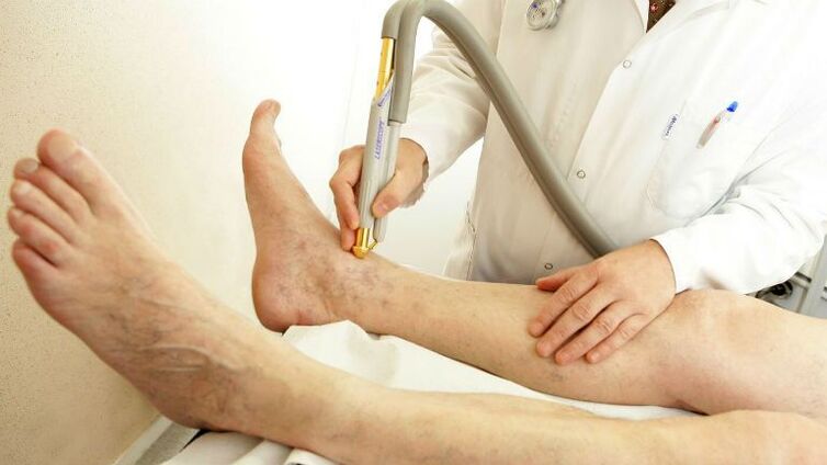 Varicose veins of the inner legs
