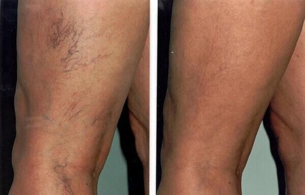 Photos before and after varicose vein treatment
