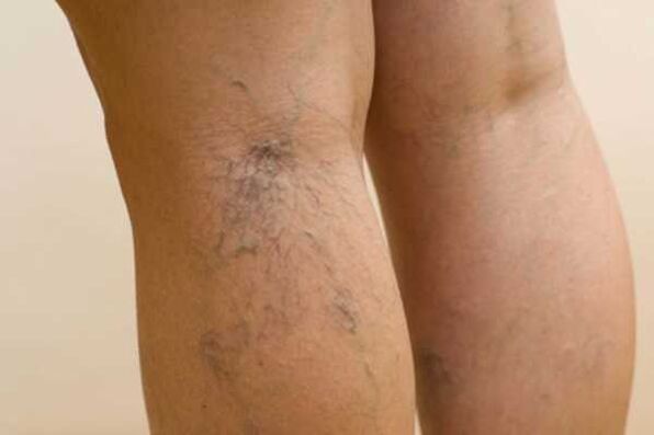 Varicose veins on the leg